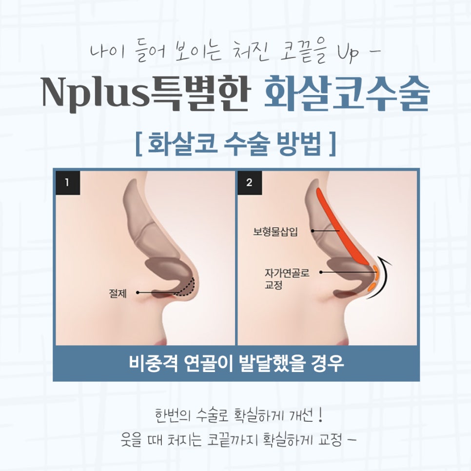 화살코수술 자세하게 알아보고 관련 이미지 7