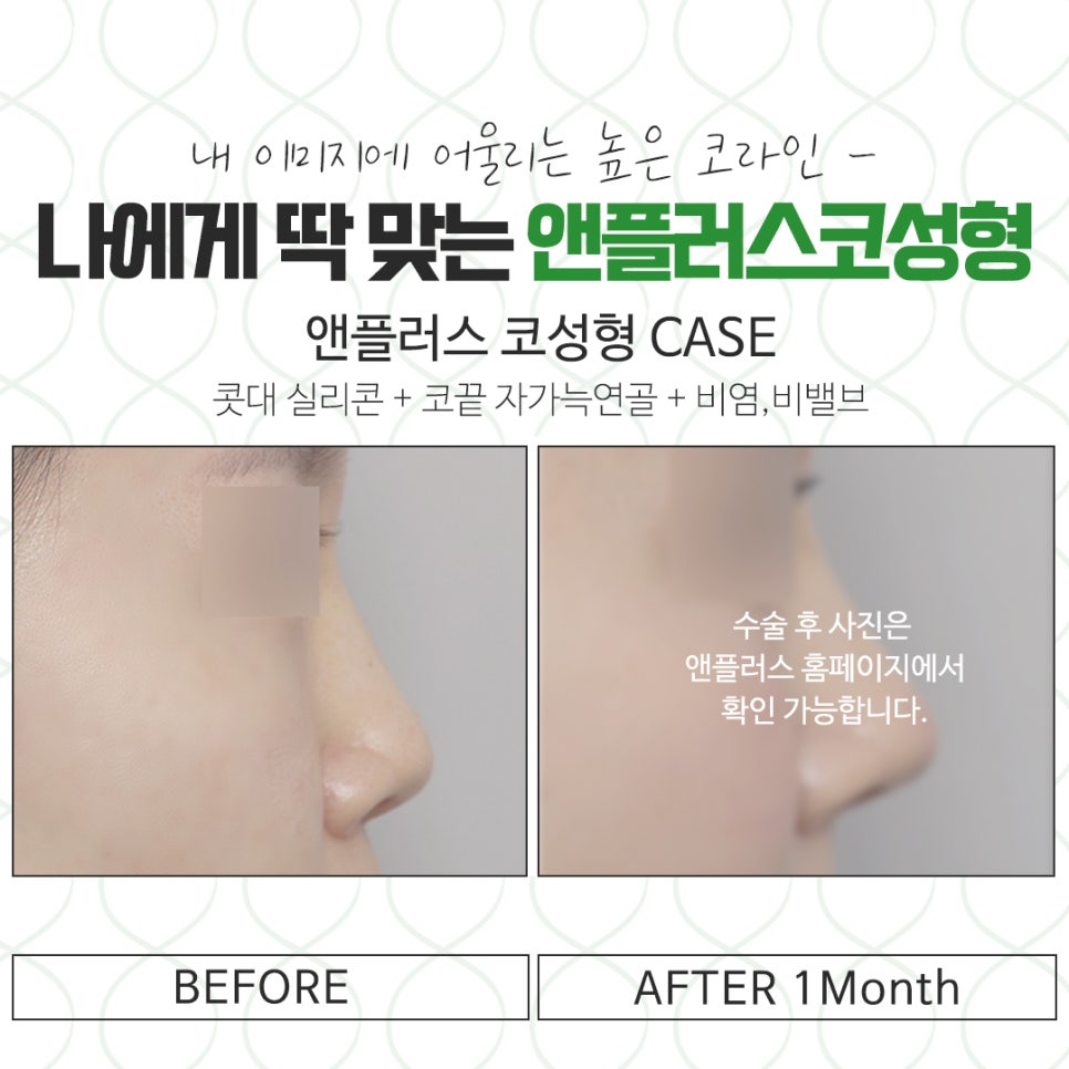 코뼈골절 다양한 방법으로 관련 이미지 14