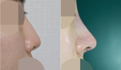 <앤플러스 성형외과> 비염코성형 수술직후 사진 관련 이미지 1