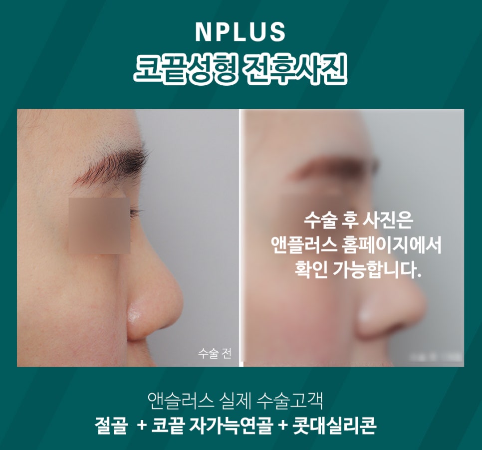 A Detailed, Careful Review of Tip Rhinoplasty image 2