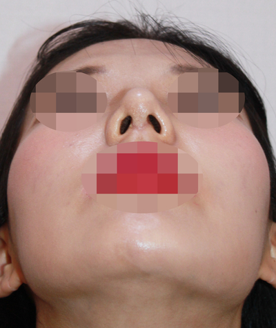 1_여자 매부리코 수술전후 관련 이미지 10