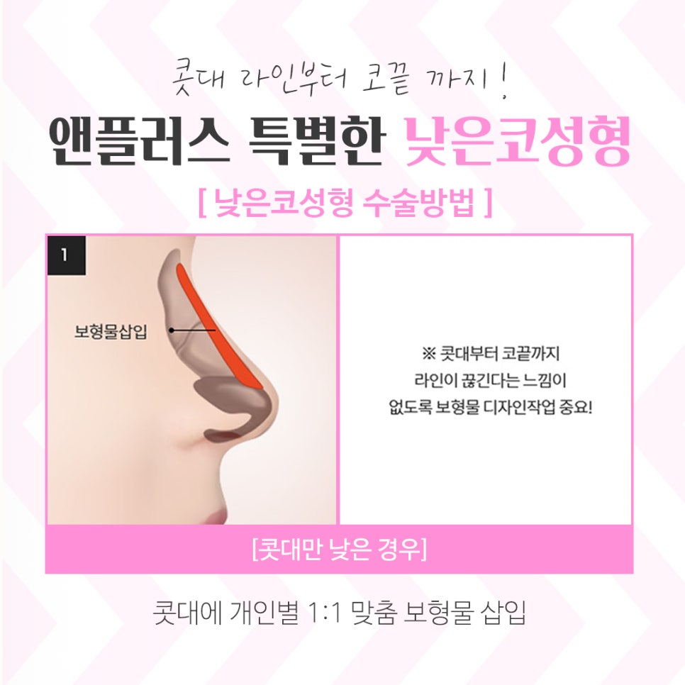 낮은코수술후기 확인하고 예쁜 라인으로 관련 이미지 8