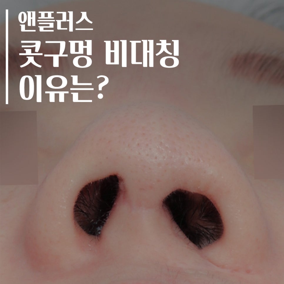 콧구멍비대칭 짝짝이에 대한 내용 정리! 관련 이미지 1