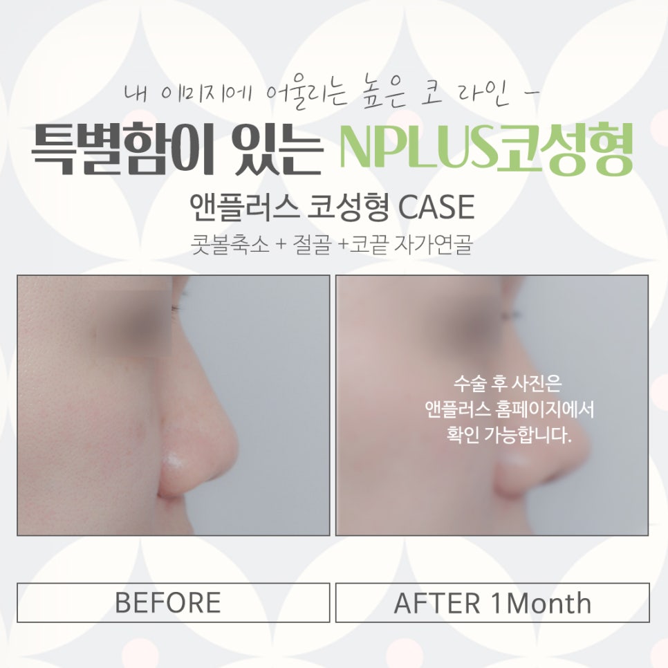 코수술잘하는곳에서 예쁘고 자연스럽게 관련 이미지 14