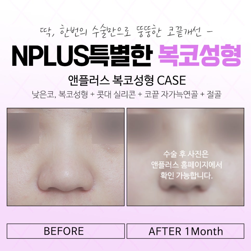 복코수술후기 날렵하고 세련된 라인으로 관련 이미지 15