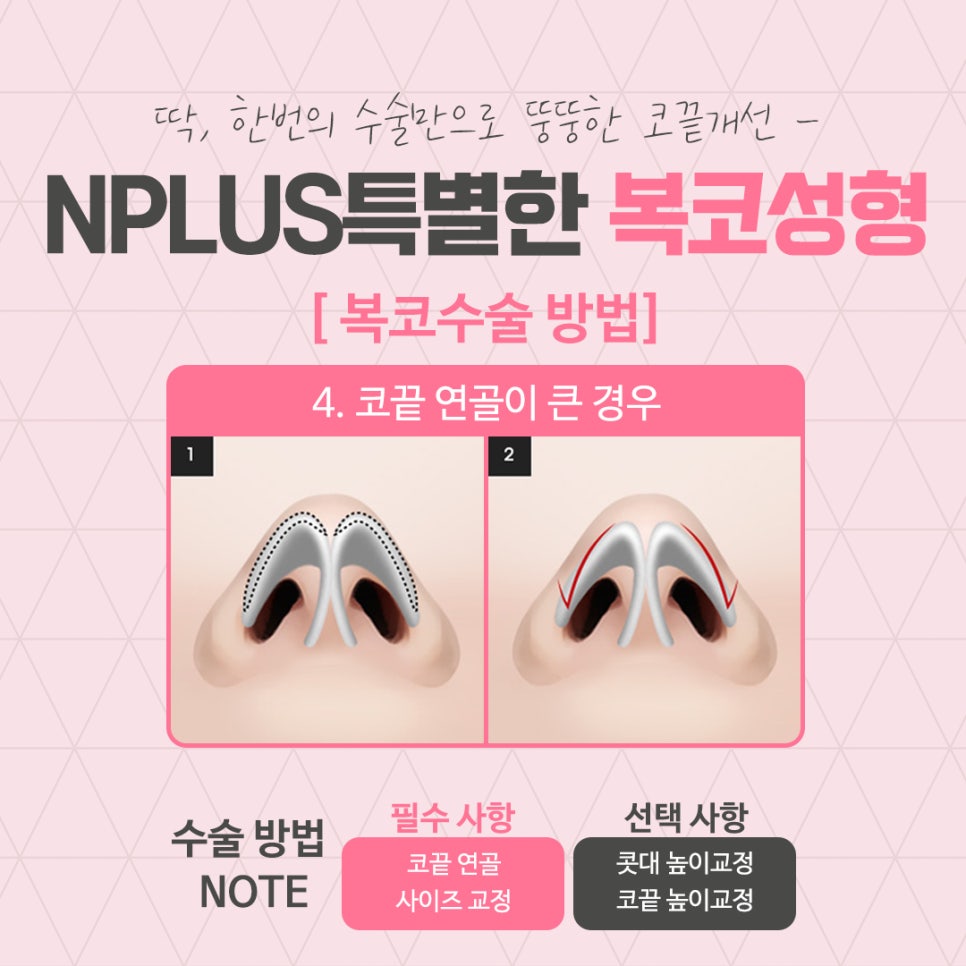 코지방제거를 통해 세련된 라인으로 관련 이미지 9