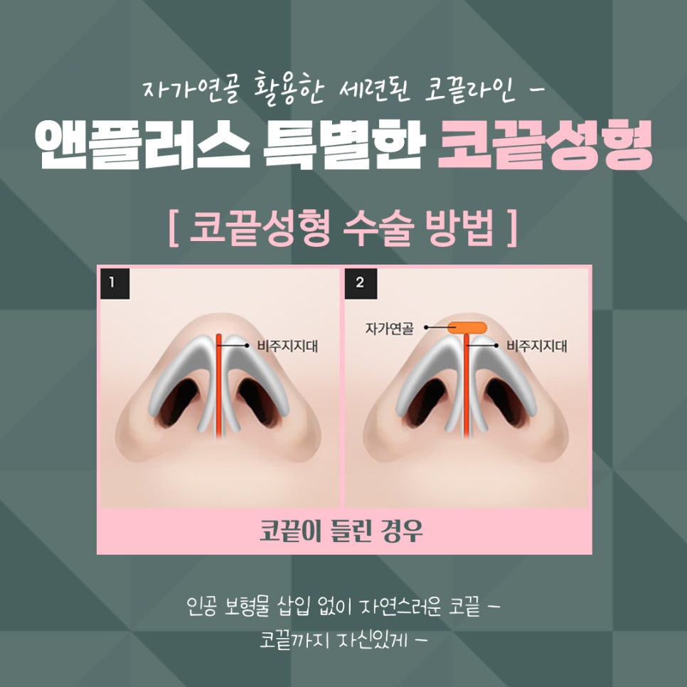 Nasal Tip Surgery Review Using Autologous Cartilage image 9