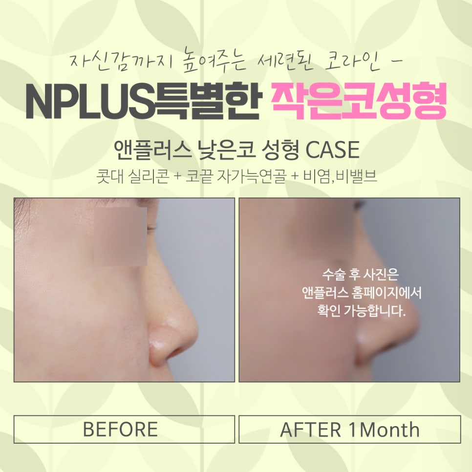 작은코수술 오지코병원에서 확실하게 확인해 보고 관련 이미지 14