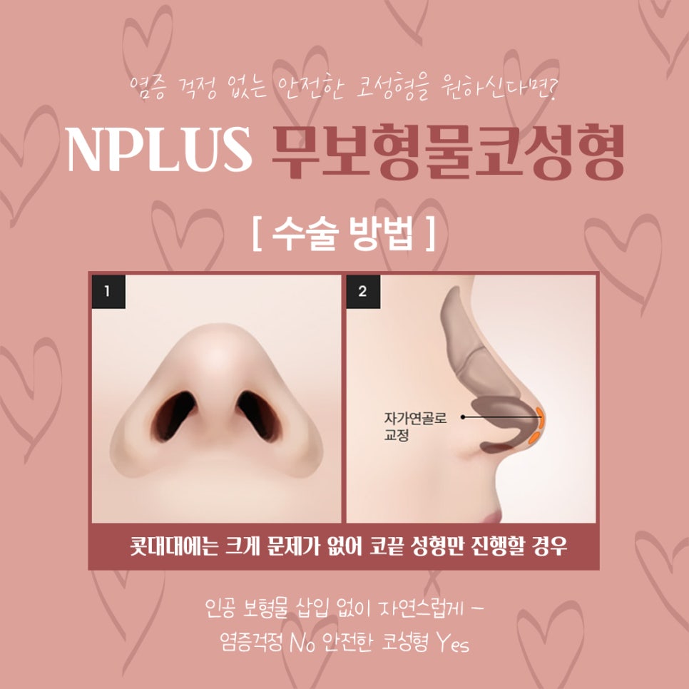 무보형물코수술후기 자연스러운 코라인으로 관련 이미지 8