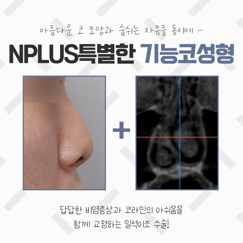 비염코성형실비 꼼꼼하게 체크하고 관련 이미지 3