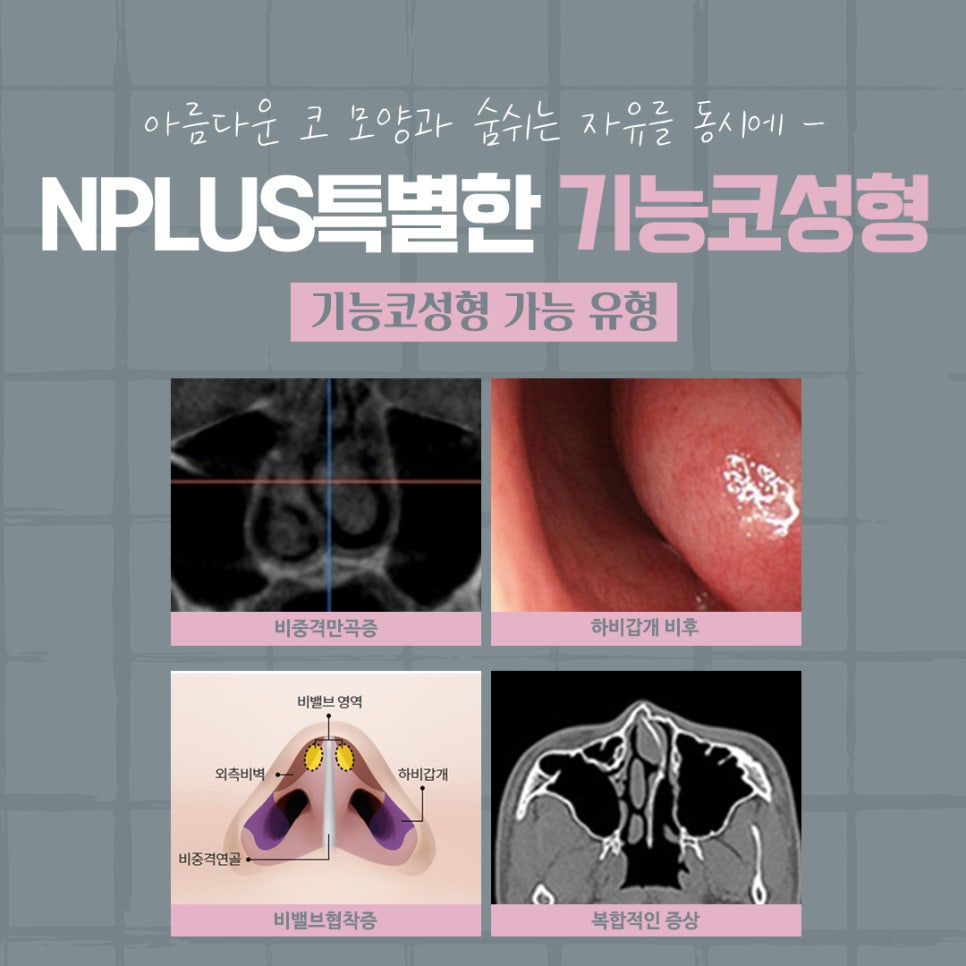 코성형후기 자연스럽고 예쁘게 관련 이미지 5