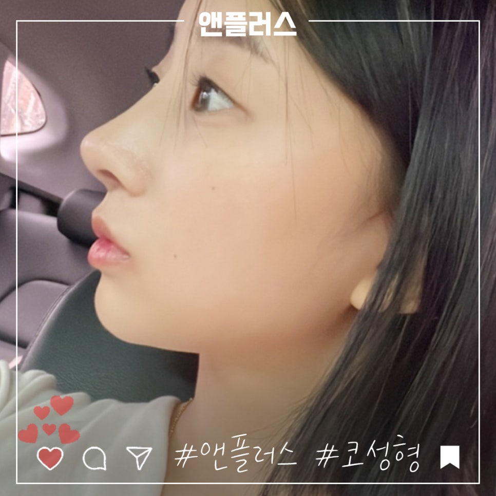 앤플러스의원에서 전해드리는 코성형후기 관련 이미지 10