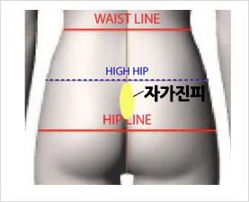 Check Whether a Non-Implant Rhinoplasty Is Possible in Your Case! image 7