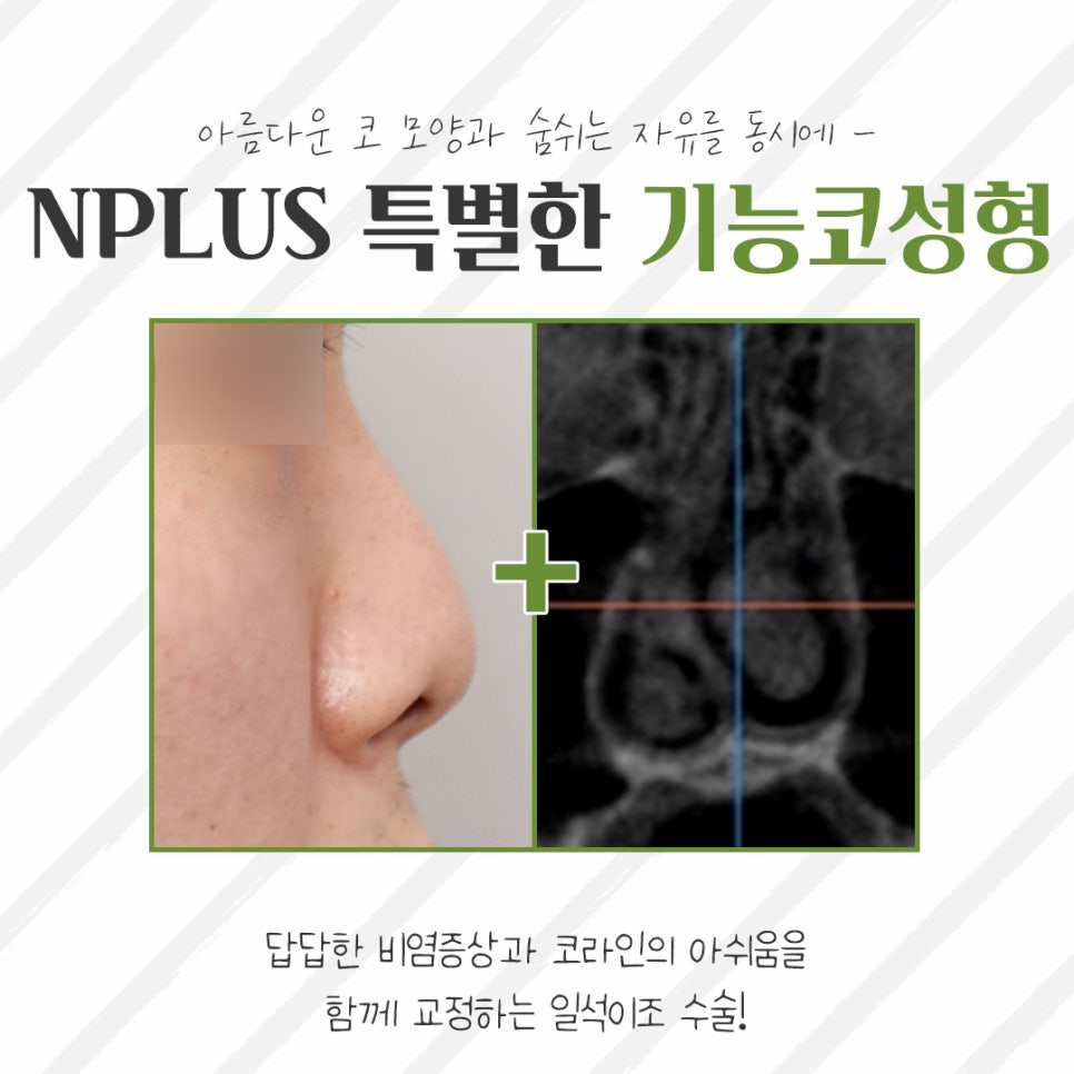 The Importance of Choosing a Female Rhinoplasty Review image 4