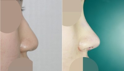 앤플러스 성형외과 _ 휜코, 복코성형 전후 관련 이미지 1