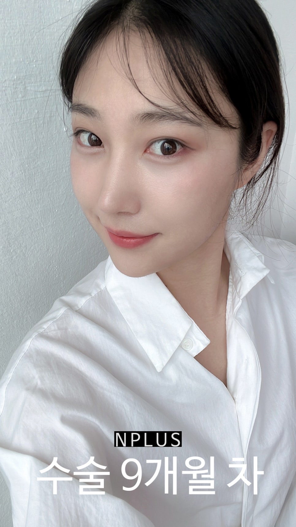 앤플러스에서 진행된 매부리코성형후기 관련 이미지 13