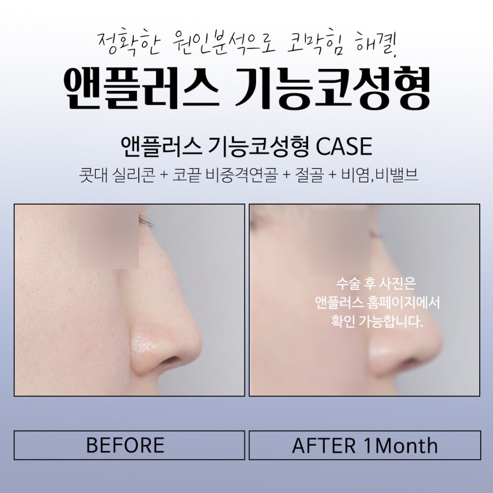 기능코성형비용에 대해 자세히 찾아보고 관련 이미지 12
