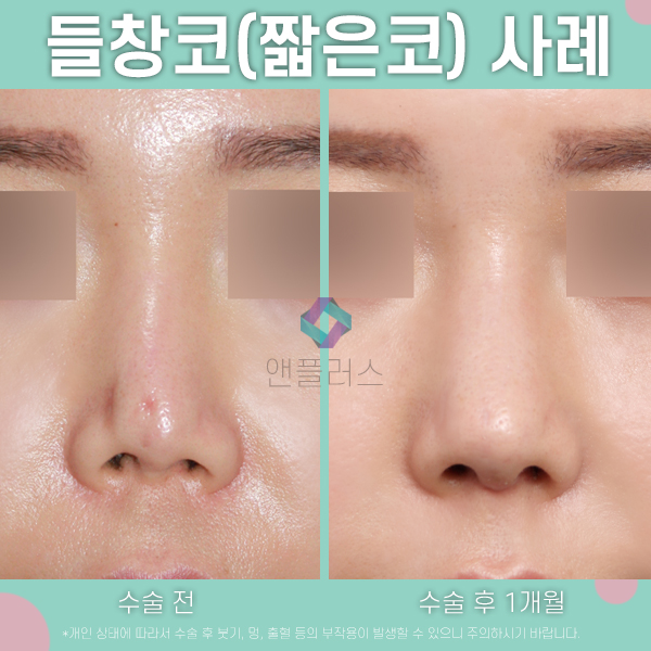 짧은코성형 복합적 교정방법 관련 이미지 1