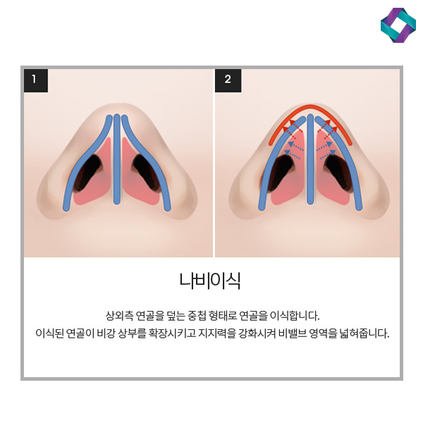 비염수술코성형 비밸브 교정술! 관련 이미지 8