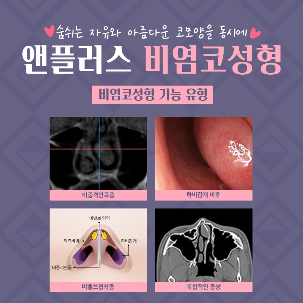 강남앤플러스 비염수술후기 관련 이미지 5