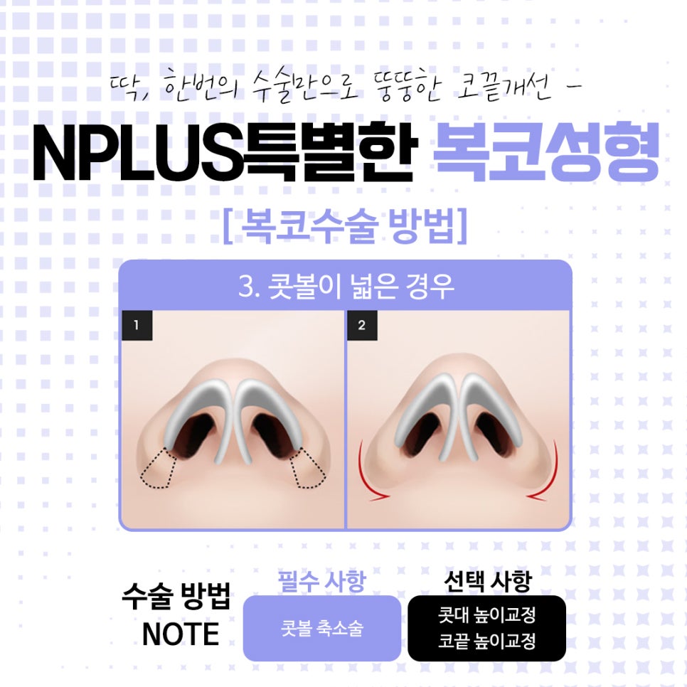 복코수술전후에 대해 자세히 찾아보고 관련 이미지 10