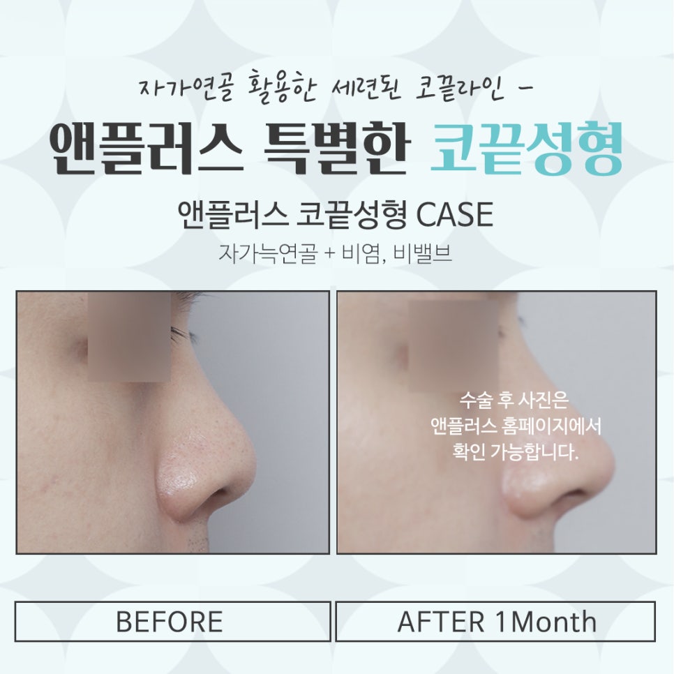 Looking Into Tip Rhinoplasty Reviews and a Natural-Looking Image image 17