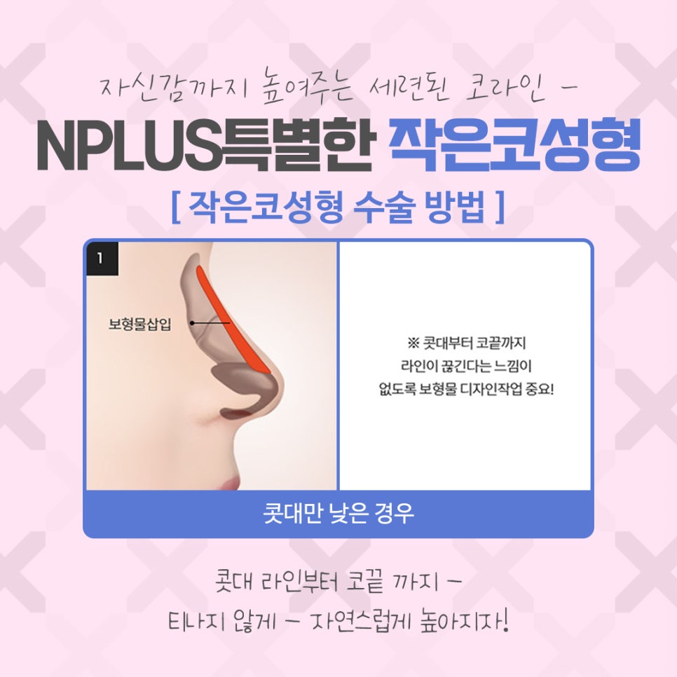 Carefully Reviewing Small Nose Surgery Reviews image 9