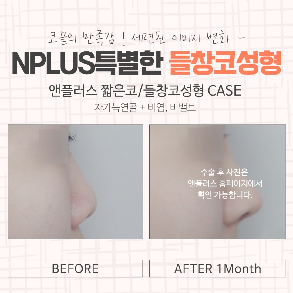 Learn More About Upturned Nose Rhinoplasty in Detail image 15