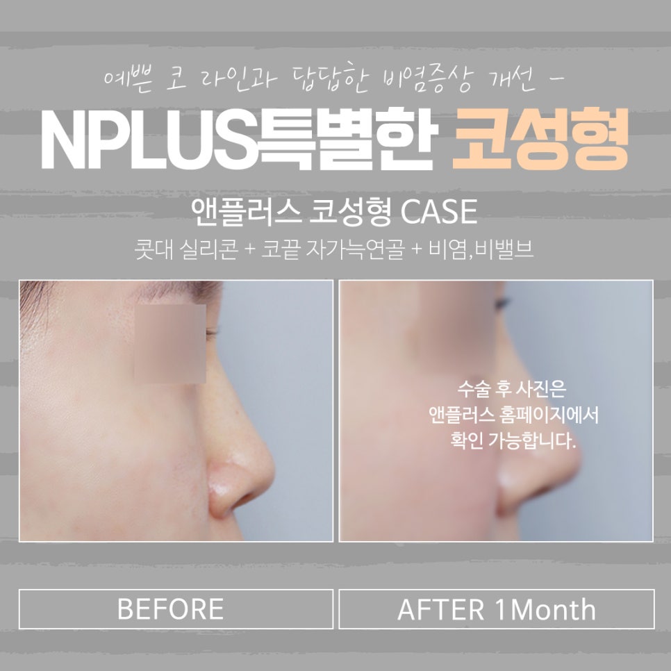 The Importance of Choosing Low Nose Augmentation Reviews image 14