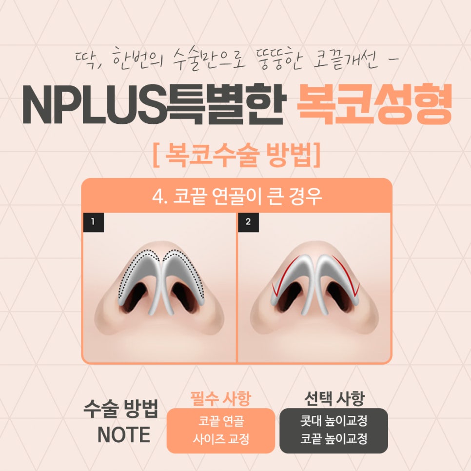 A Clear Bulbous Nose Surgery Review with Nasal Fat Removal image 9