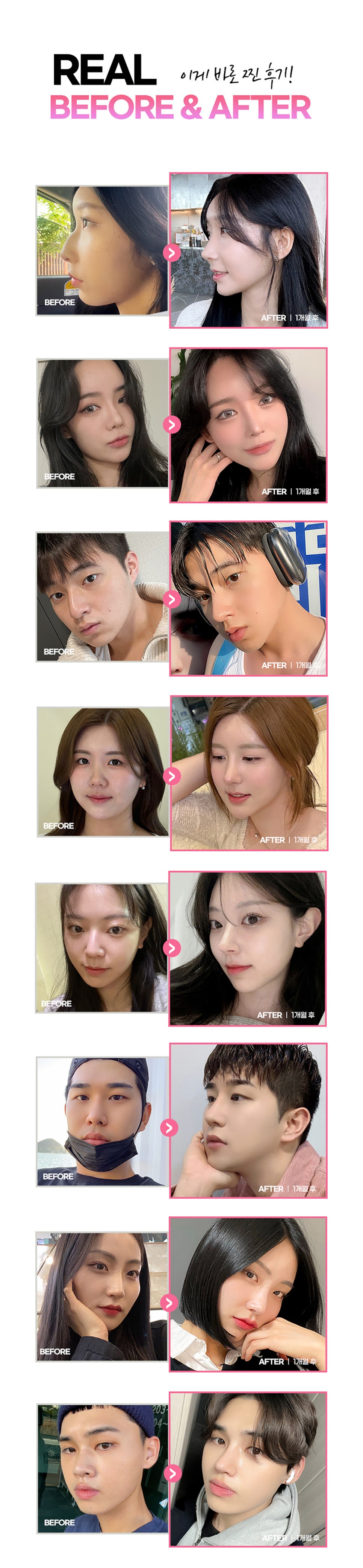 앤플러스의원 코성형EVENT&hearts; 관련 이미지 4