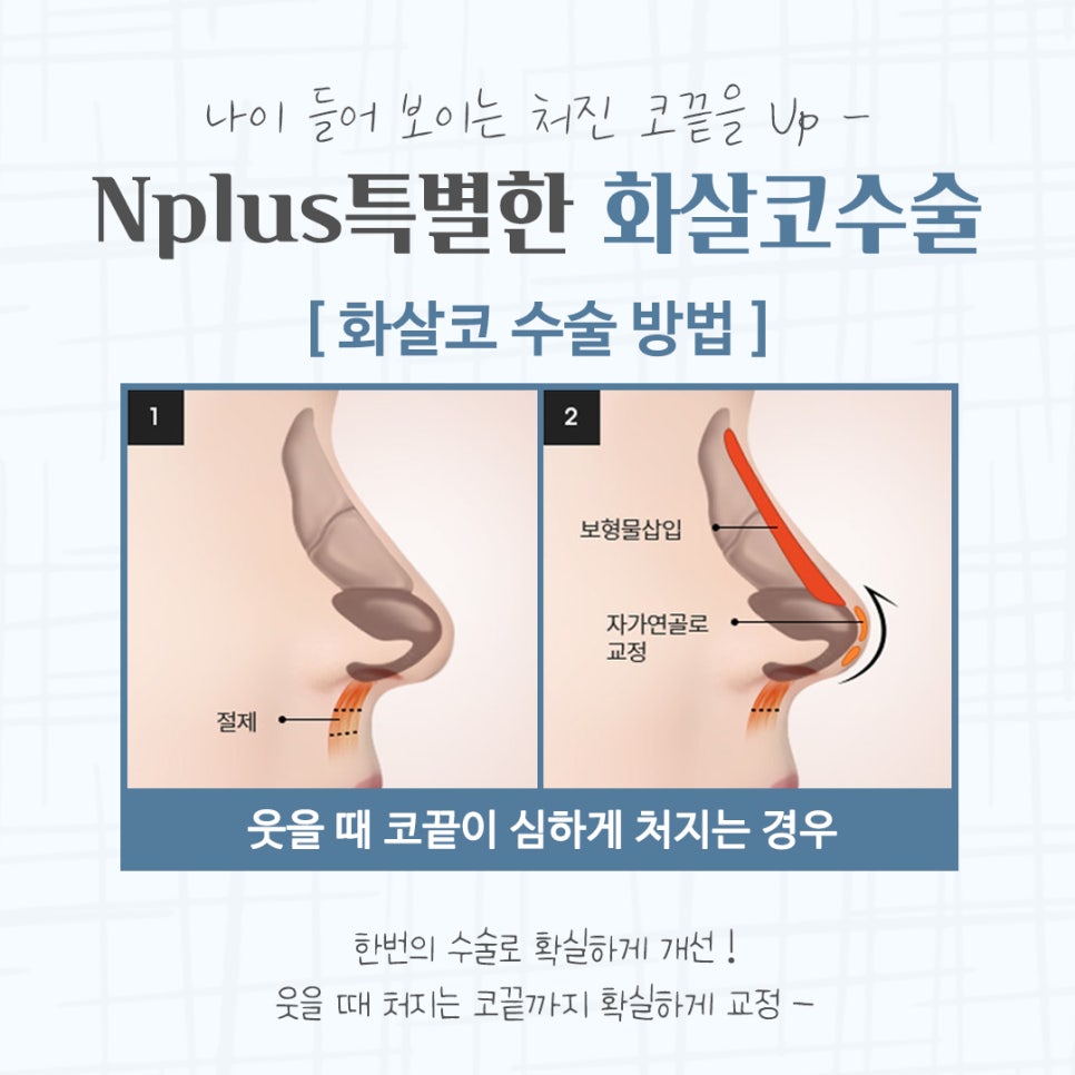화살코수술 자세하게 알아보고 관련 이미지 9