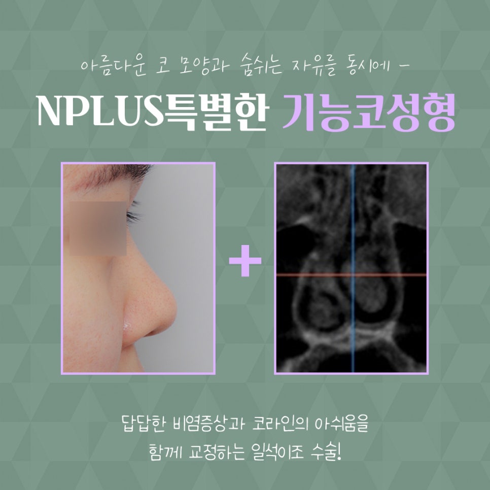 코수술후기 라인까지 고려해서 관련 이미지 5