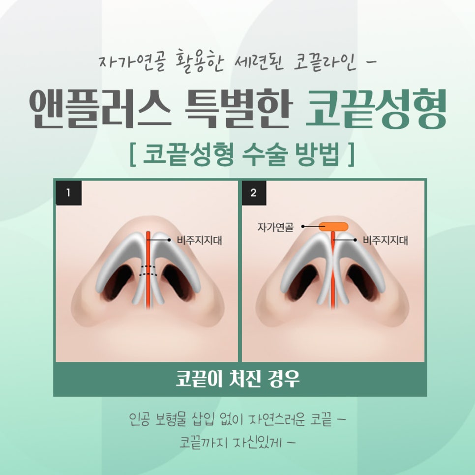 코끝성형후기를 확인하고 자연스럽게 교정하여 관련 이미지 9