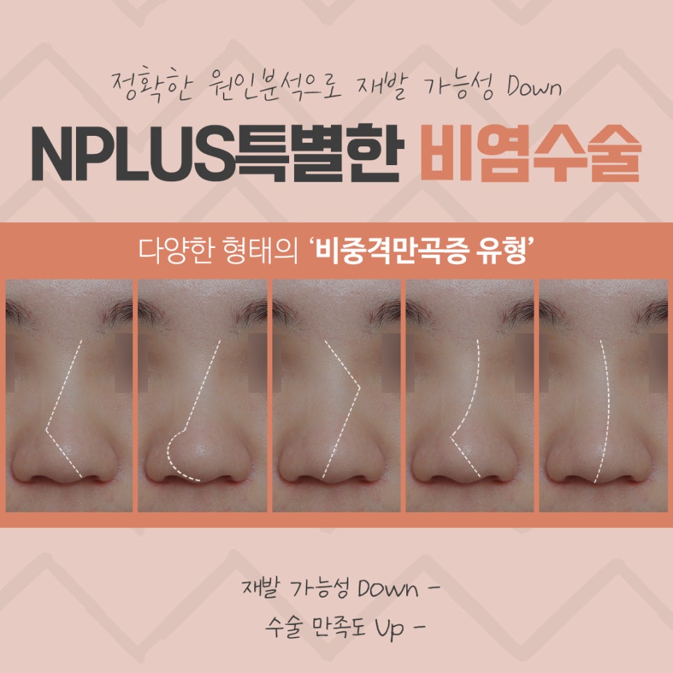 비중격수술후기 정확하게 파악해야 관련 이미지 5