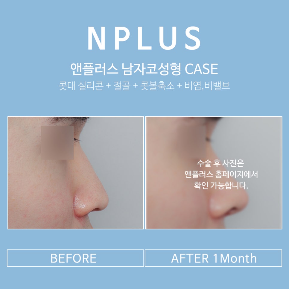 남자코성형후기 기능까지 추가하여 관련 이미지 9