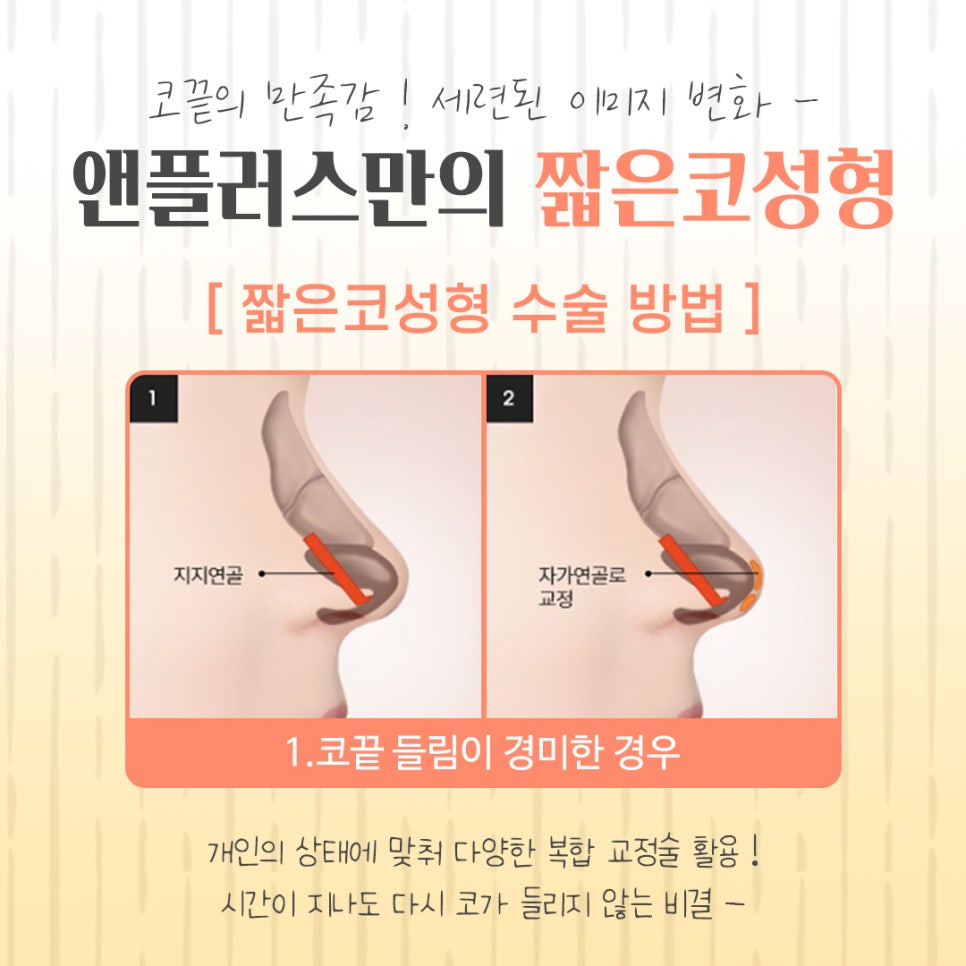Addressing the Problems of Short Nose Surgery image 8