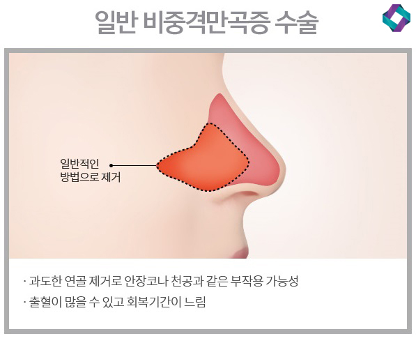 기능코성형 비중격만곡증(비중격교정술)과 코막힘원인 관련 이미지 9
