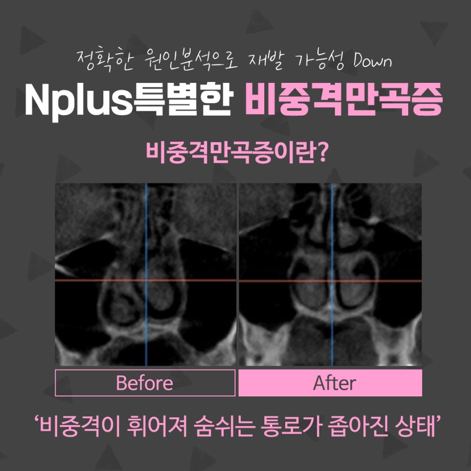 비중격만곡증수술 신중한 선택으로 관련 이미지 4