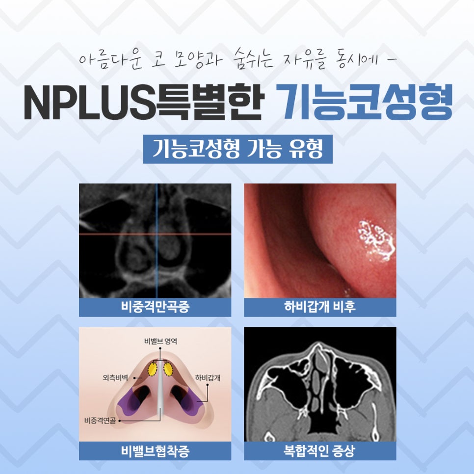 비염수술전후 확실한 차이를 알아보고 관련 이미지 5