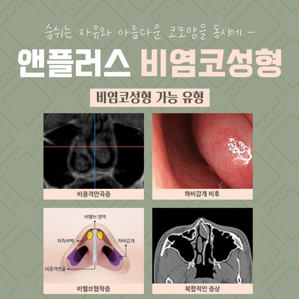 비염코성형후기 라인까지 고려하여 관련 이미지 4