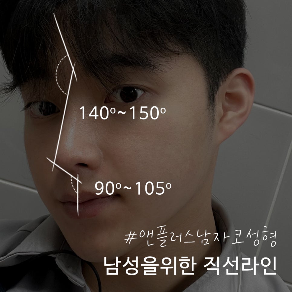 남자코수술전후 라인까지 고려하여 관련 이미지 5