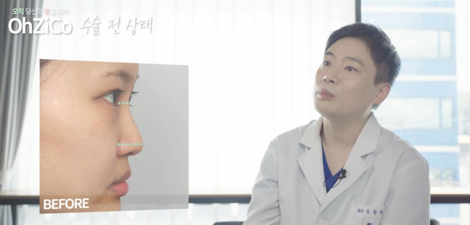 짧은코수술 후기까지 자세하게 알아보고 관련 이미지 3