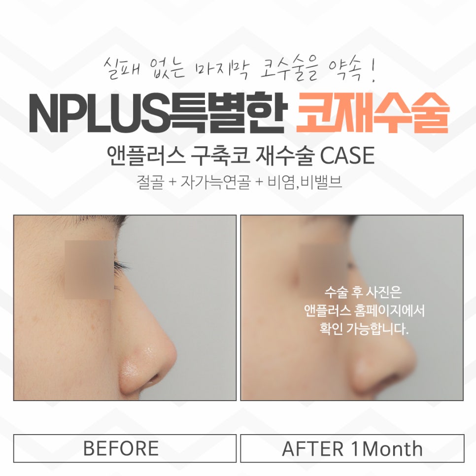 서울코재수술을 자세하게 알아보고 관련 이미지 11
