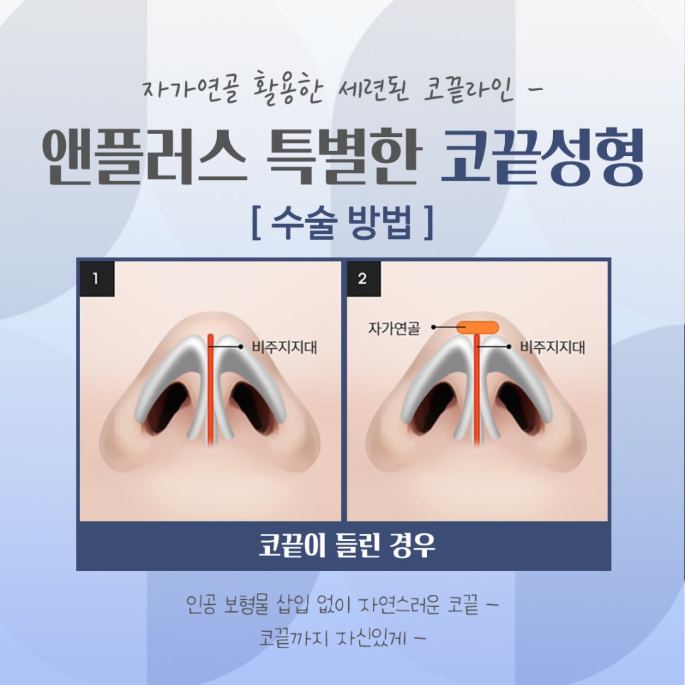 Looking Into Tip Rhinoplasty Reviews in Detail image 9