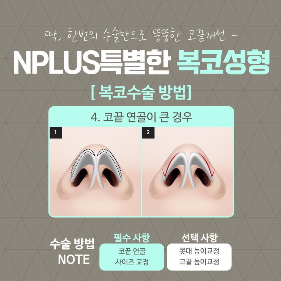 복코수술후기를  확인하고 세련된 이미지로 관련 이미지 12
