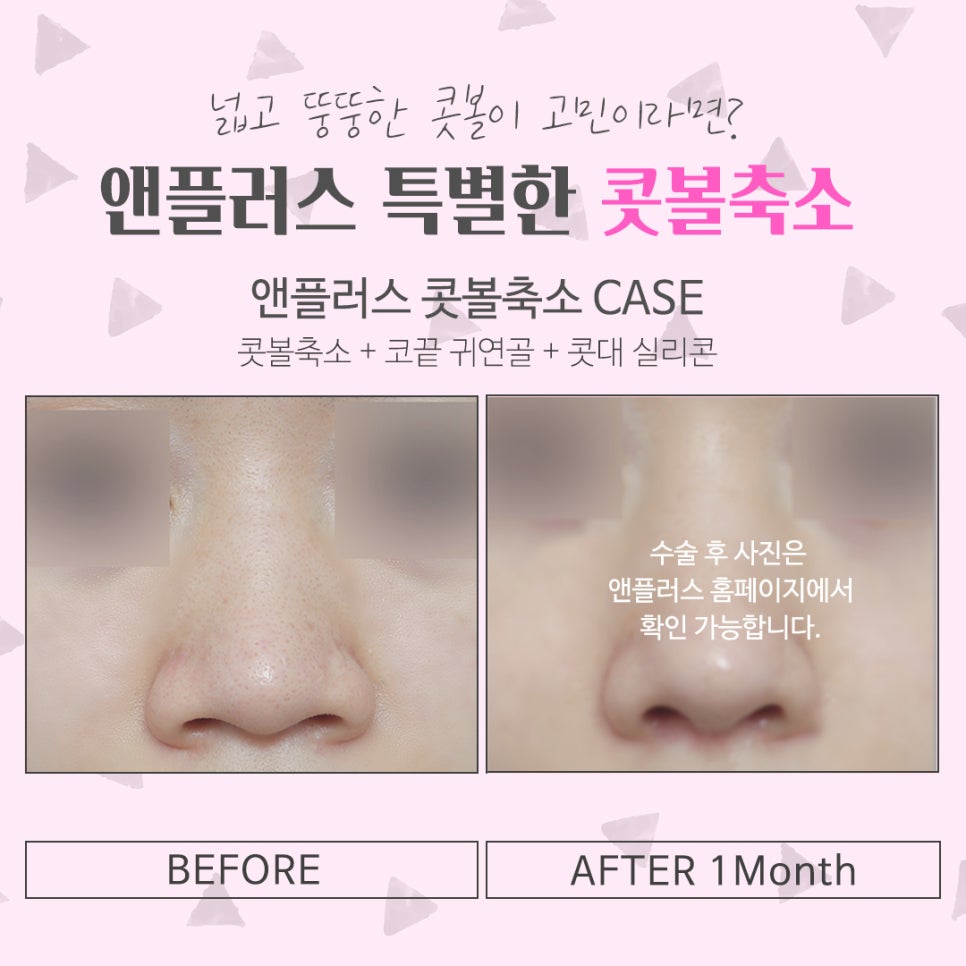 If You Want to Learn About Nostril Reduction Reviews image 13