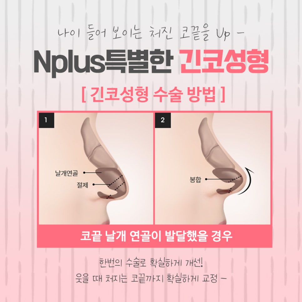 긴코성형 자연스럽게 교정하여 관련 이미지 8