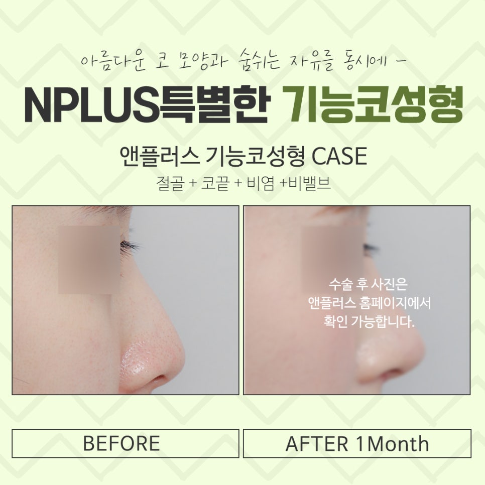 Rhinoplasty for Rhinitis at a Good ENT Clinic image 15