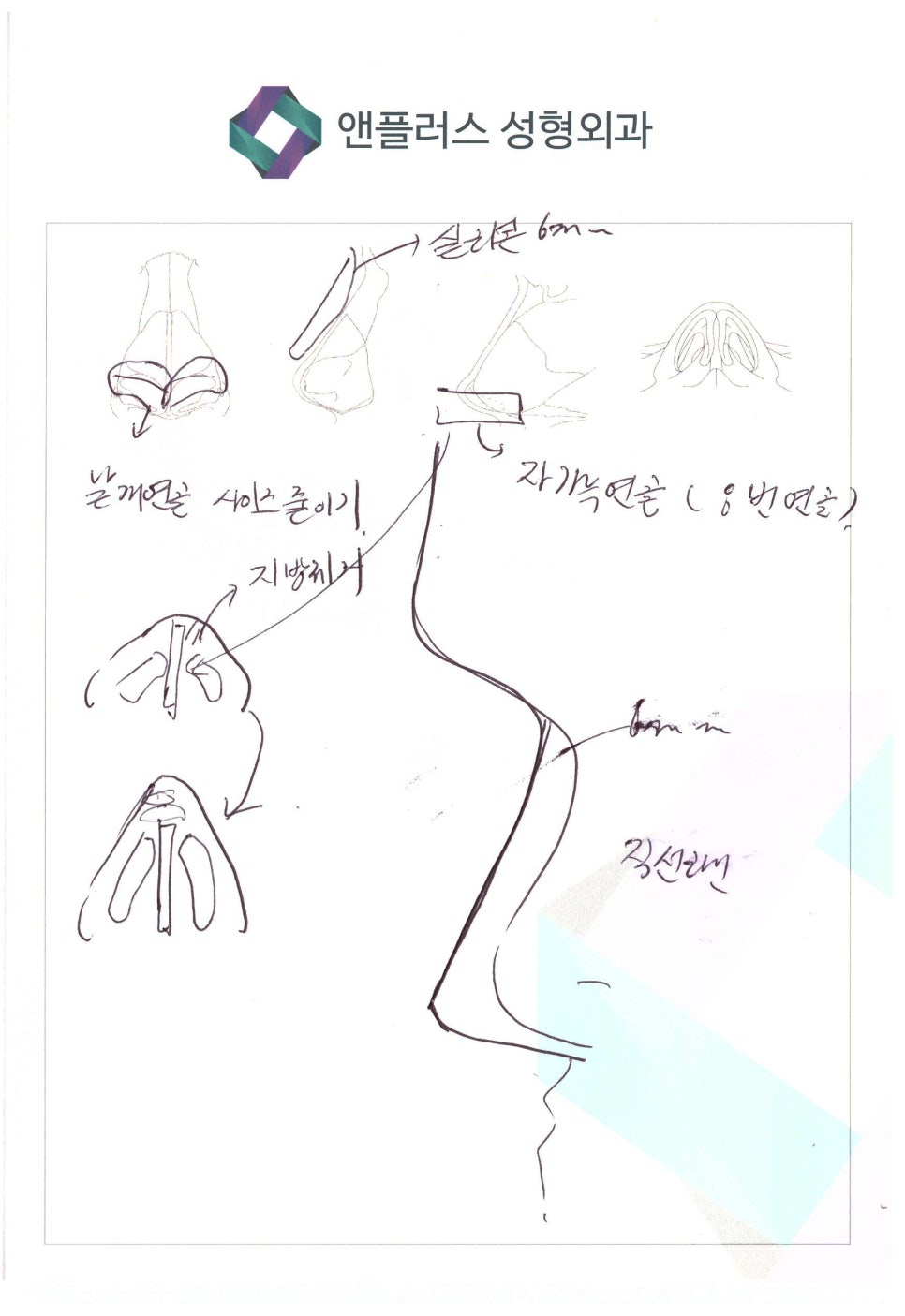 복코수술후기_뭉툭한 코라인을 자연스럽게 관련 이미지 5